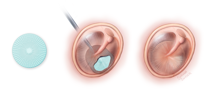 Desktop Health Buys Tech for 3D Printing Eardrum Grafts