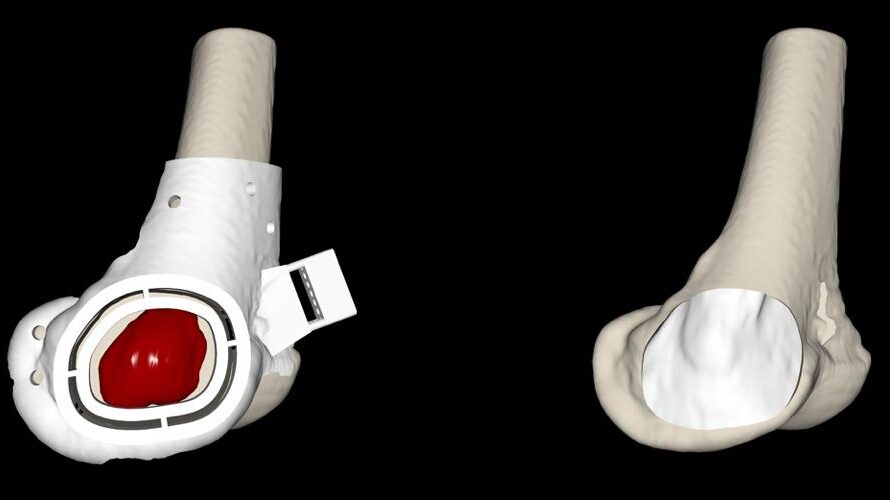 Bodycad Introduces Bodycad OnCall for Custom 3D Printed Orthopedic Implants and Restorations