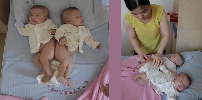 Twins, Joined at the Butt, Will be Separated Tomorrow Thanks to 3D Printing Technology