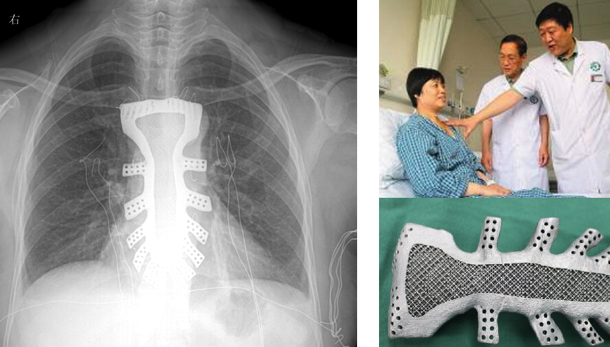 Woman With the Metal Chest: Surgeons Implant World’s First 3D Printed Titanium Sternum