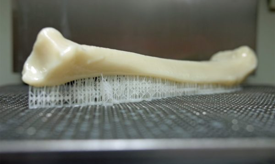 Dinsmore and the Children’s Hospital of Orange County Show Value of Patient-Specific 3D Printed Tibia Model